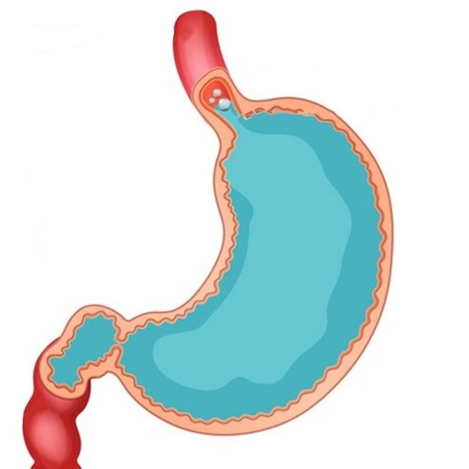 Acid Reflux