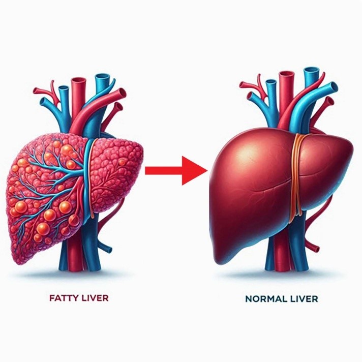 Fatty Liver